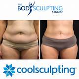 Pictures of How Much Is A Coolsculpting Treatment