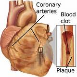 Coronary Artery Disease Home Remedies Images