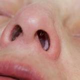 Sinus Polyps Natural Treatment Pictures