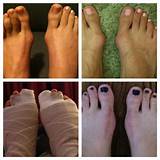 Foot Surgery For Bunions Recovery Images