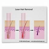 Photos of Laser Hair Removal Quotes