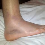 Swollen Ankle Sprain Treatment Pictures