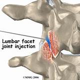 Images of Lumbar Facet Joint Syndrome Treatment