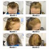 Images of How Much Is Hair Loss Treatment