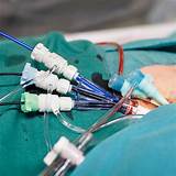 Heart Catheter Ablation Recovery Pictures