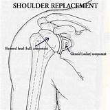 Shoulder Replacement Recovery Photos