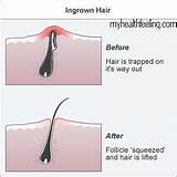 Ingrown Hair Abscess Treatment Images