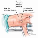 Images of Heart Ablation Procedure Recovery