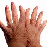 Humira For Rheumatoid Arthritis Side Effects Photos