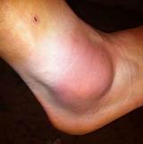 Pictures of Swollen Ankle Sprain Treatment