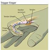 Finger Physical Therapy Photos