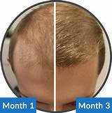 Male Hair Loss Treatment Photos