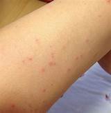 Scabies Doctor Images