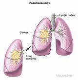 Removal Of Spot On Lung Pictures