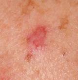 Benign Skin Cancer Treatment Images