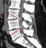 Cervical Spine Fracture Treatment Images