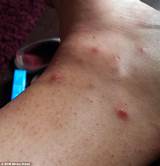 Pictures of Bee Sting Treatment For Ms