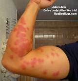 Pictures of Does Bed Bug Spray Kill Scabies