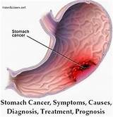 Stomach Cancer Prognosis Mayo Clinic Pictures