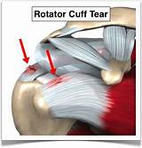 Photos of Rotator Cuff Recovery Time