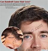 Photos of Does Medication Cause Hair Loss