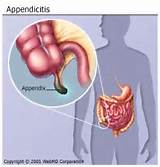 Pictures of Appendix Cancer Treatment