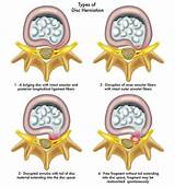 Images of Laser Treatment For Bulging Disc