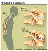 Can Ankylosing Spondylitis Cause Weight Loss Images
