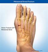 Bruised Vertebrae Treatment Images