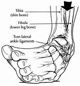 Images of Ankle Ligament Surgery Brostrom Recovery Time