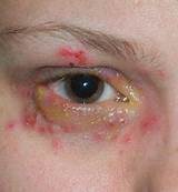 Herpes Around The Eye Treatment Images