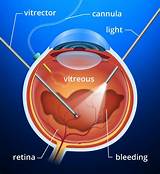 Scleral Buckle Surgery Recovery Photos