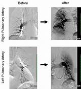 Tpa Treatment For Pulmonary Embolism Images