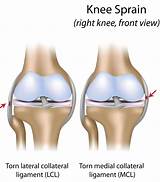 Photos of Mcl Muscle Strengthening