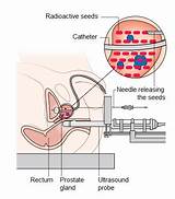 Radiation Seed Therapy