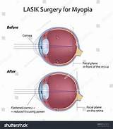 Lasik Eye Surgery Procedure Time Images