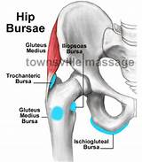 Photos of Trochanteric Bursitis Surgery Recovery Time