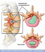 Herniated Disk L5 S1 Treatment