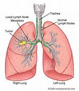 Images of Lung Cancer Breathing Exercises
