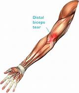 Photos of Lower Bicep Tendonitis Treatment