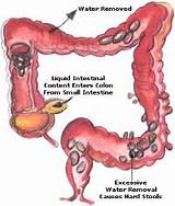 Navel Displacement Home Remedies Photos