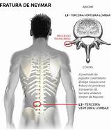 Pictures of Fractured T12 Vertebrae Recovery Time