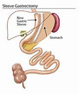 Cost Of Gastric Sleeve Surgery Without Insurance
