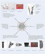 Materials Used In Dental Implants Photos