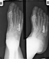 Images of Broken Foot Recovery Time