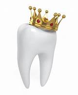 Pictures of Dental Gold Crown