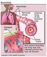 Pictures of What Is The Medical Treatment For Bronchitis