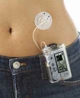Medtronic Insulin Pump Pictures