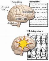 Complex Partial Seizure Disorder Treatment Pictures