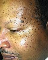 Dark Spot Removal African American Skin Images